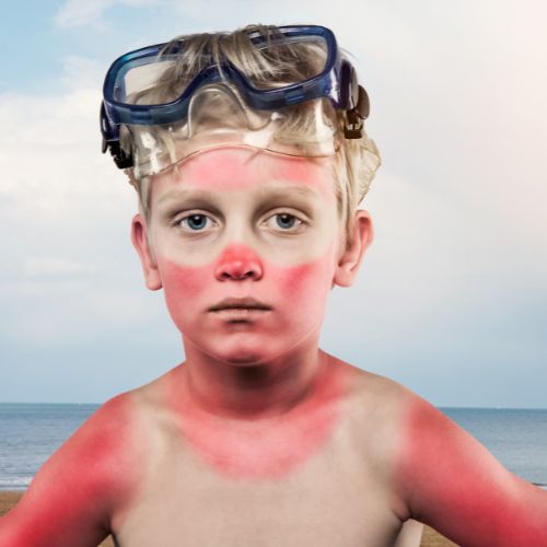 Child with severe sunburn on the face and shoulders wearing swimming goggles