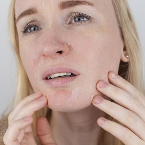 Close-up of a woman's face with dry, flaking skin on her cheeks