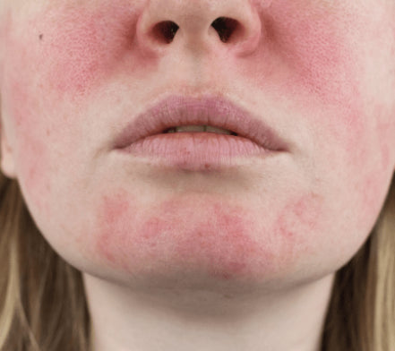 Close-up of red rosacea flushing across a woman's cheeks and chin