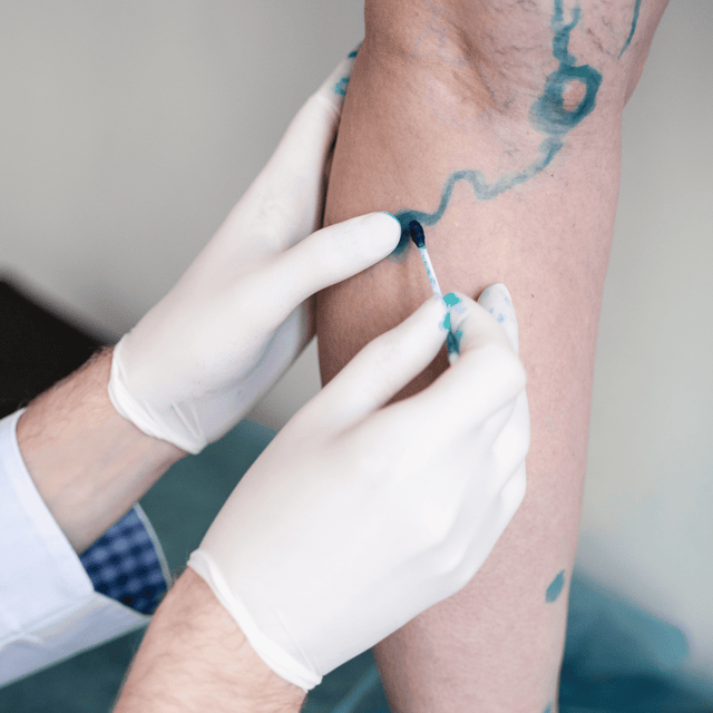 Gloved hands giving an injection into a leg with varicose veins