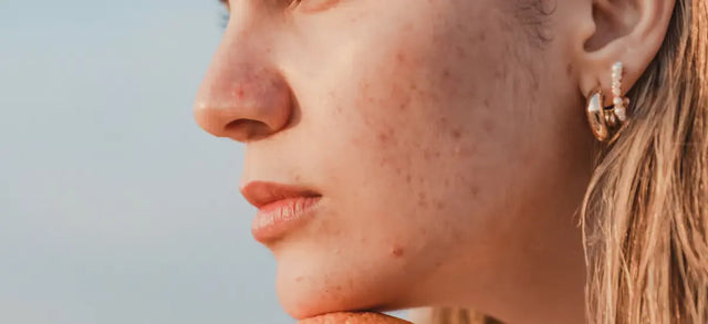Profile of a woman with acne scarring on her cheek
