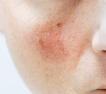 Close-up of red, irritated skin across a cheek and nose