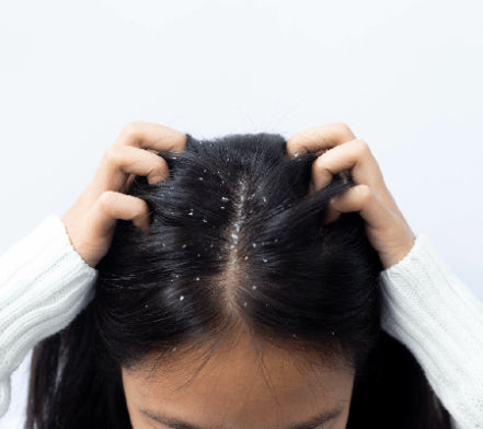 Woman parting her dark hair to show scalp flaking