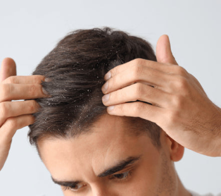 Man parting his hair to show flaking on the scalp