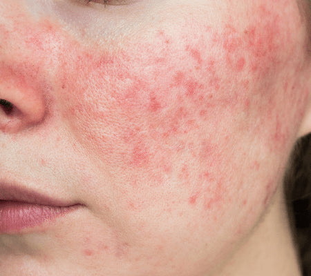 Close-up of acne rosacea spots across a woman's cheek