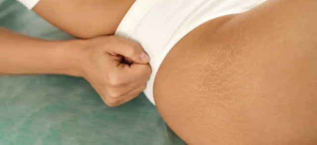Close-up of stretch marks on a person's hip