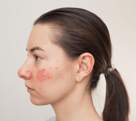 Profile of a woman with a red rosacea patch on her cheek