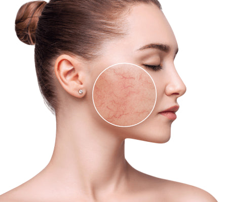 Profile of a woman's face with a circle highlighting broken capillaries on her cheek