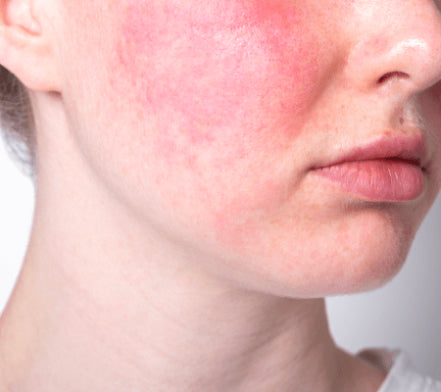 Close-up of pronounced red flushing on a woman's cheek and jaw